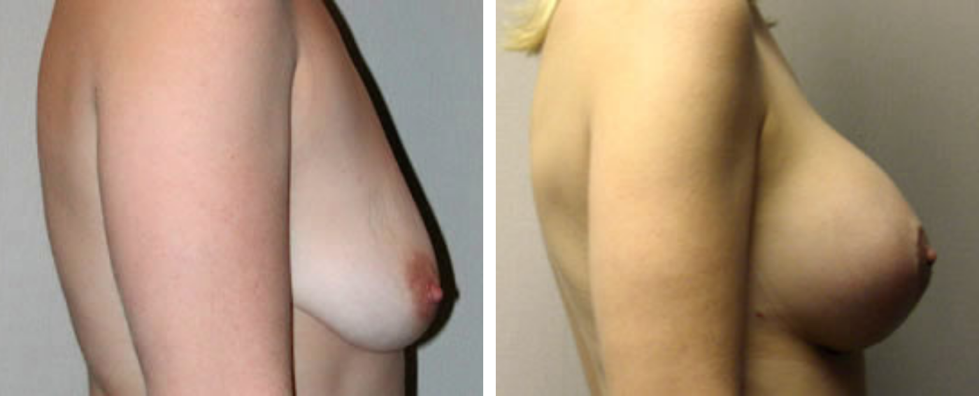 Breast Augmentation with Lollipop Lift c