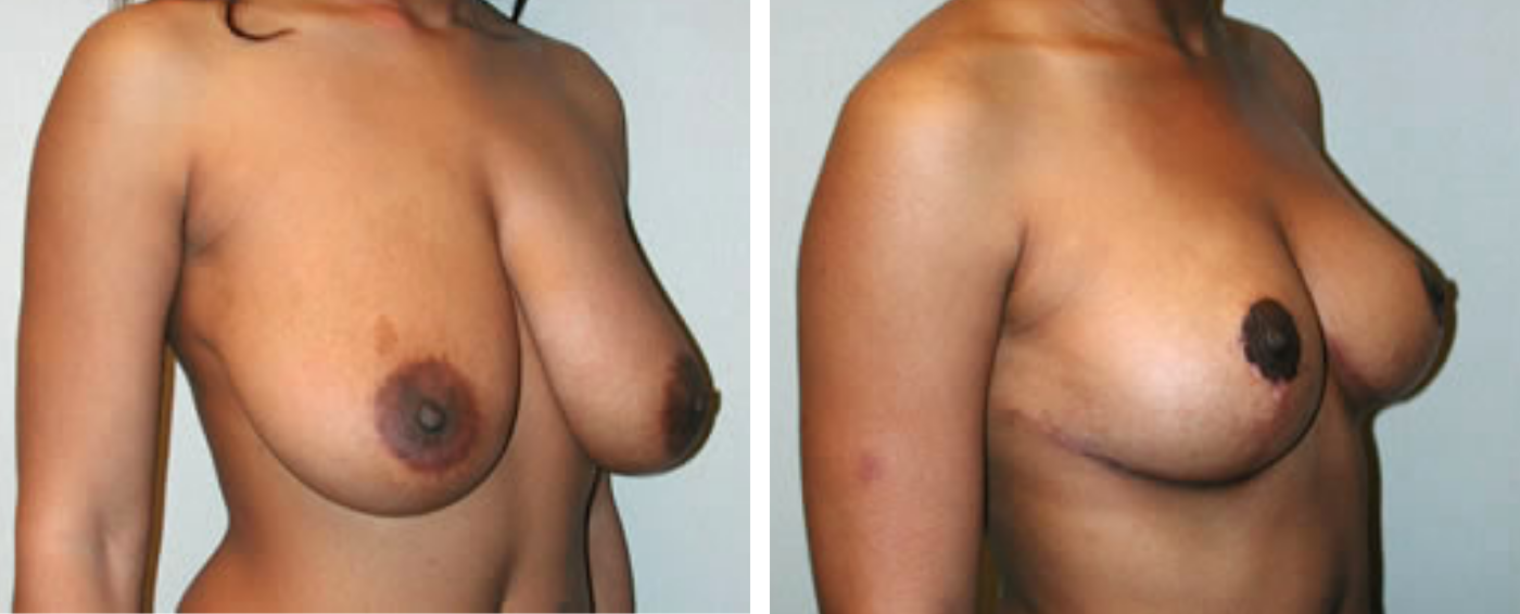 Breast lift b