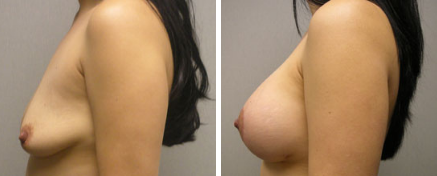 Breast Aug Periareolar lift c