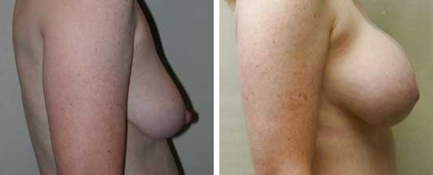 Breast Augmentation with Lollipop Lift c