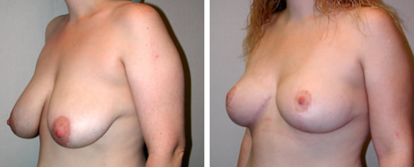 Breast lift b