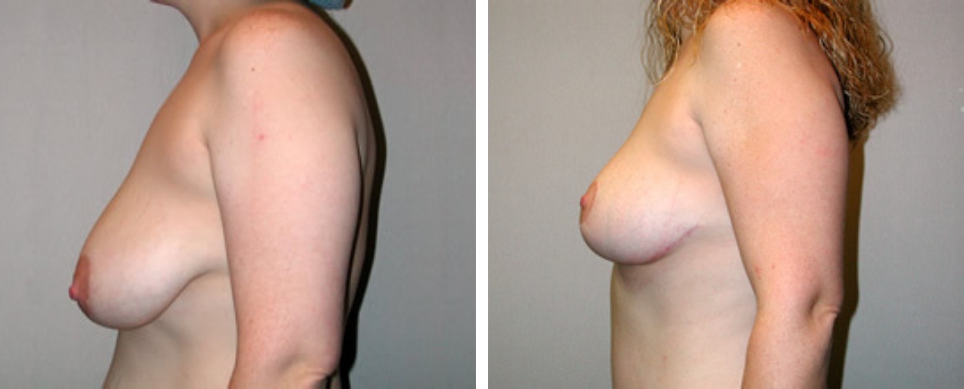 Breast lift c