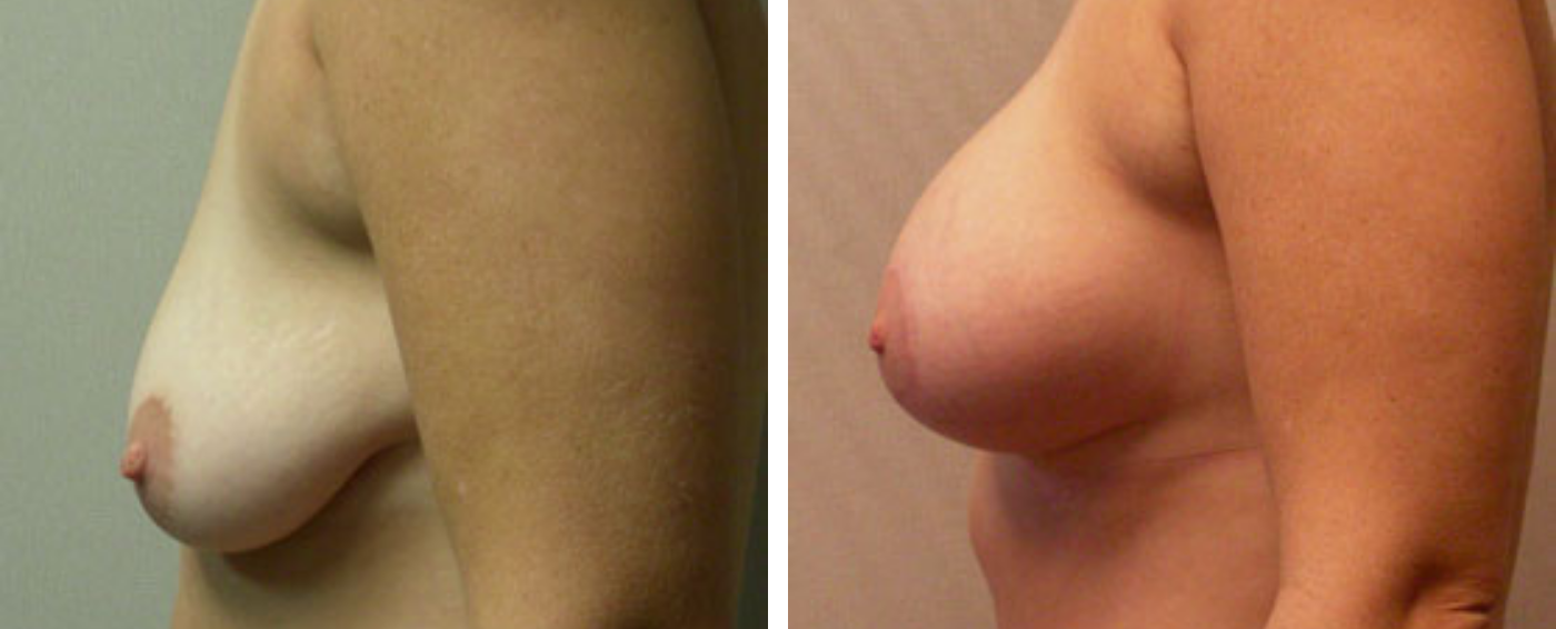 Breast Aug Periareolar lift c