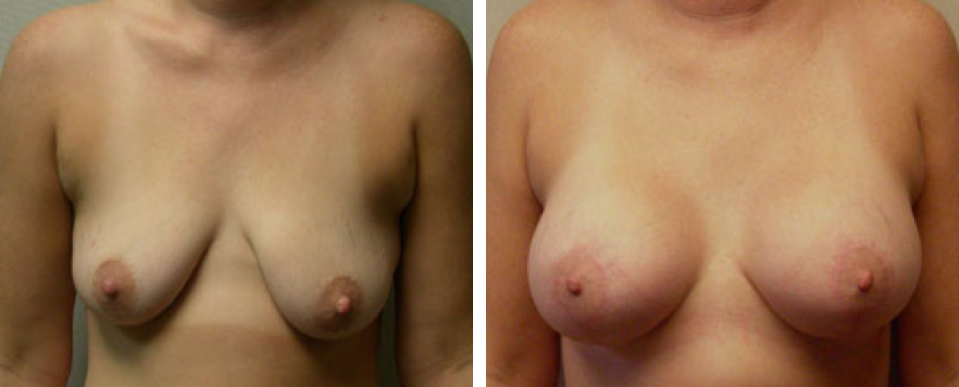 Breast Augmentation with Lollipop Lift a