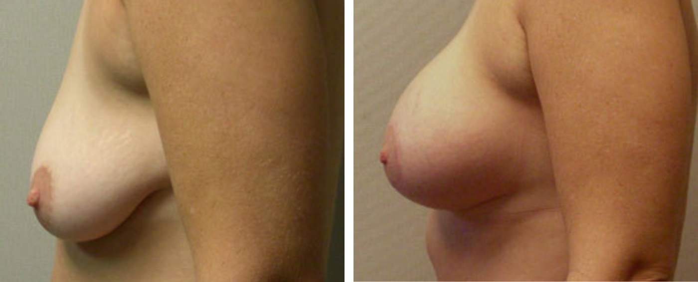 Breast Augmentation with Lollipop Lift c