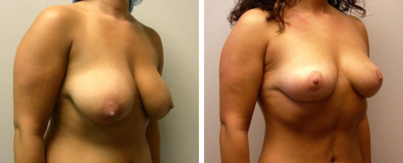 Breast lift b
