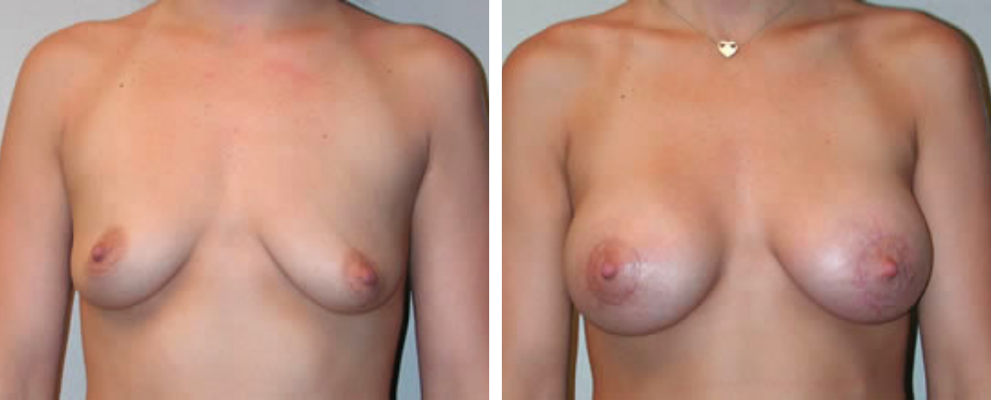 Breast Aug Periareolar lift a