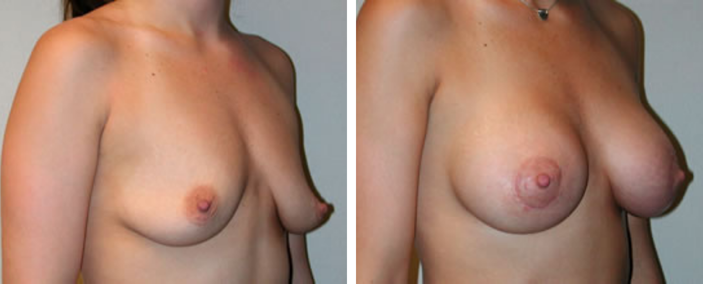 Breast Aug Periareolar lift b