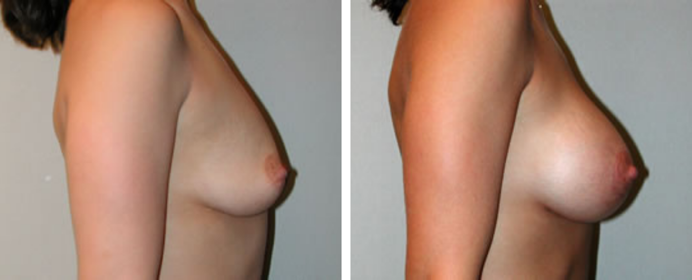 Breast Aug Periareolar lift c