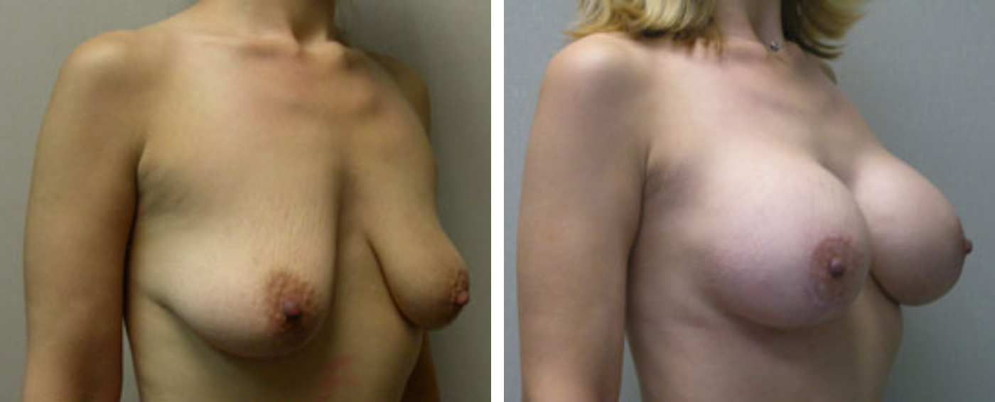 Breast Augmentation with Lollipop Lift b