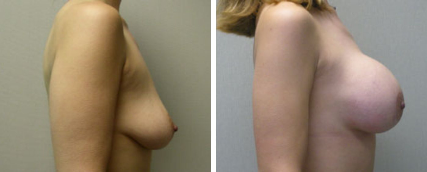 Breast Augmentation with Lollipop Lift c
