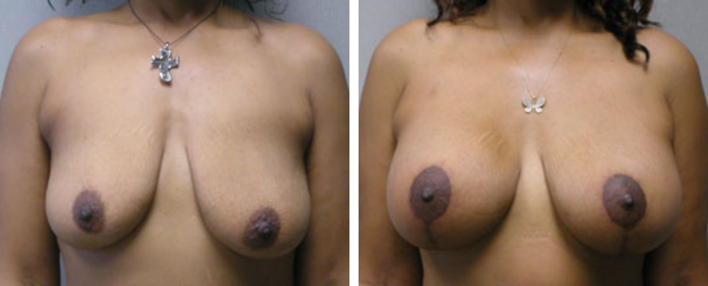 Breast Aug Periareolar lift a
