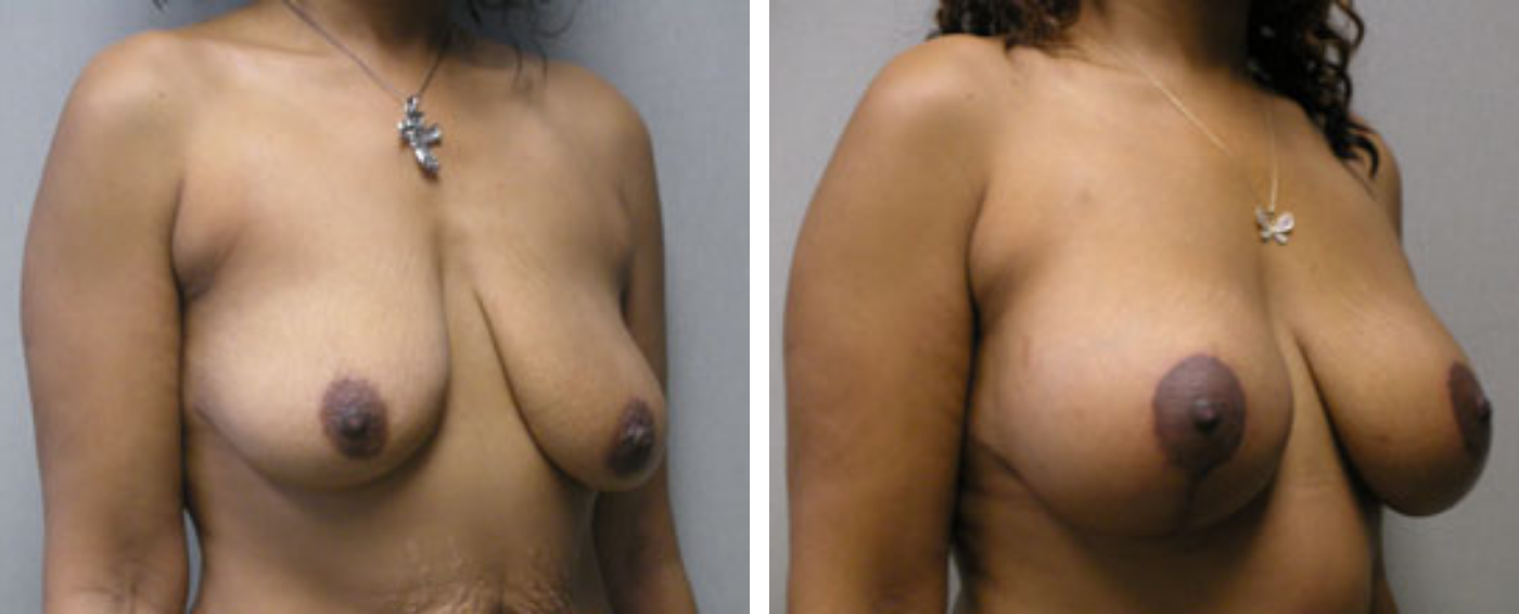 Breast Aug Periareolar lift b