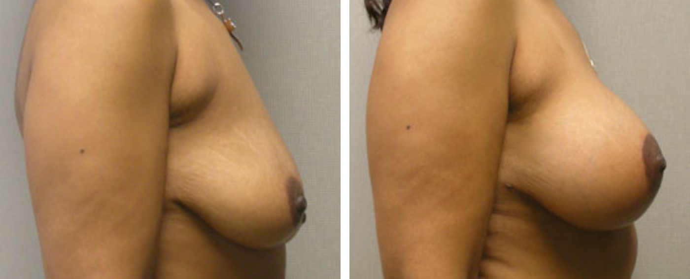 Breast Aug Periareolar lift c
