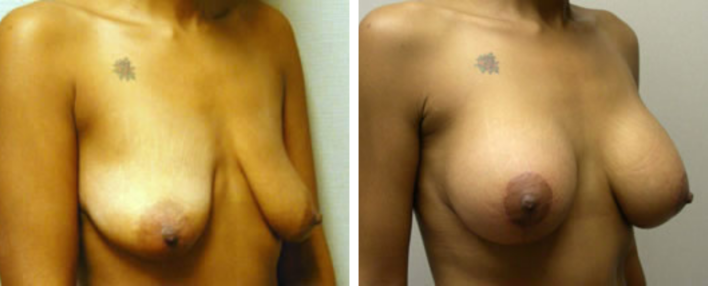 Breast Augmentation with Lollipop Lift b