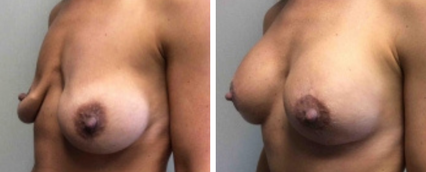 Breast Implant Removal and Replacement in Michigan b