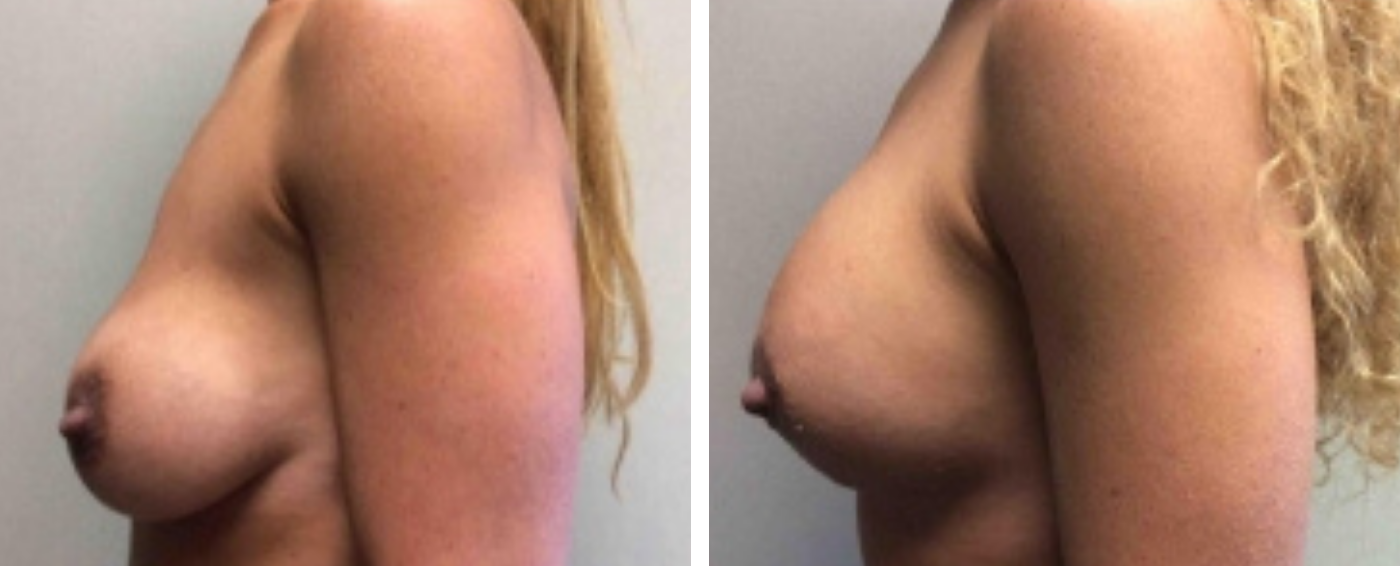 Breast Implant Removal and Replacement in Michigan c