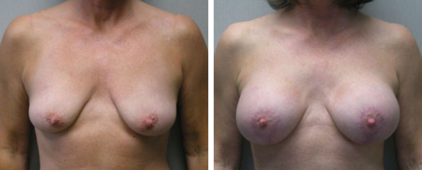 Breast Aug Periareolar lift a