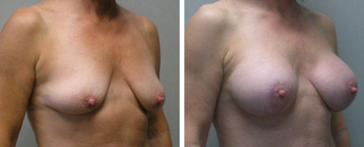 Breast Aug Periareolar lift b