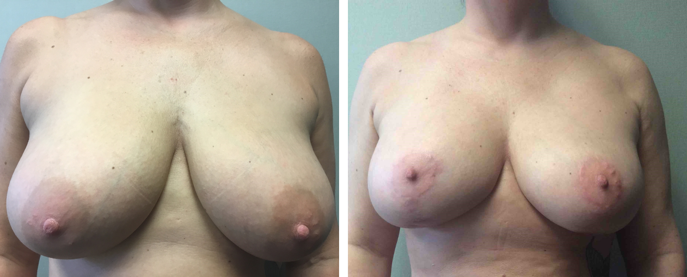 Breast Augmentation with Lollipop Lift a