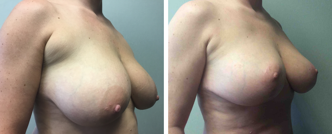Breast Augmentation with Lollipop Lift b