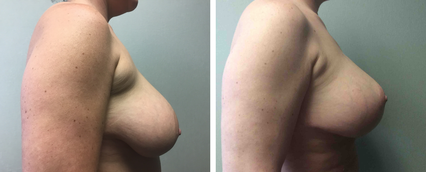 Breast Augmentation with Lollipop Lift c