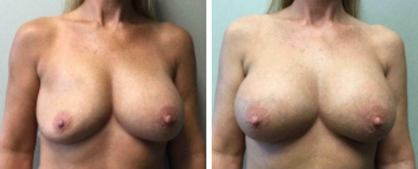 Breast Implant Removal and Replacement in Michigan a