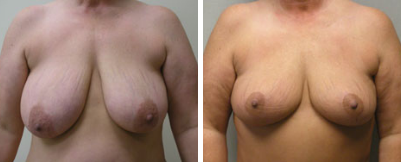 Breast lift A