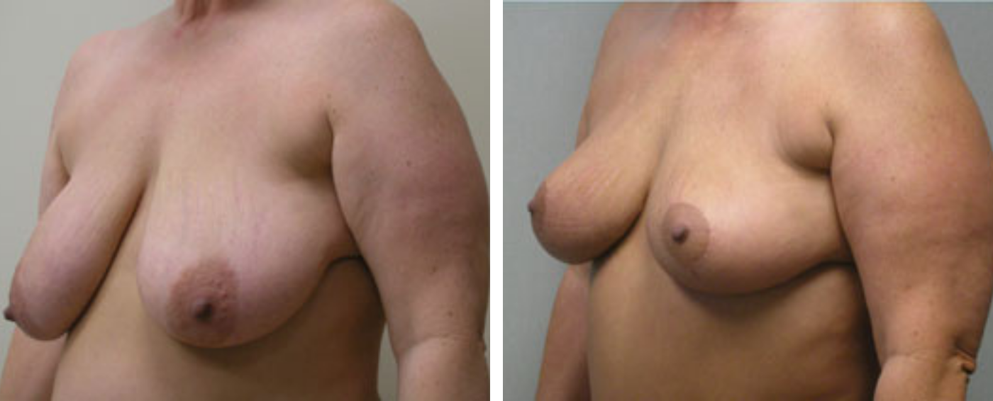Breast lift B