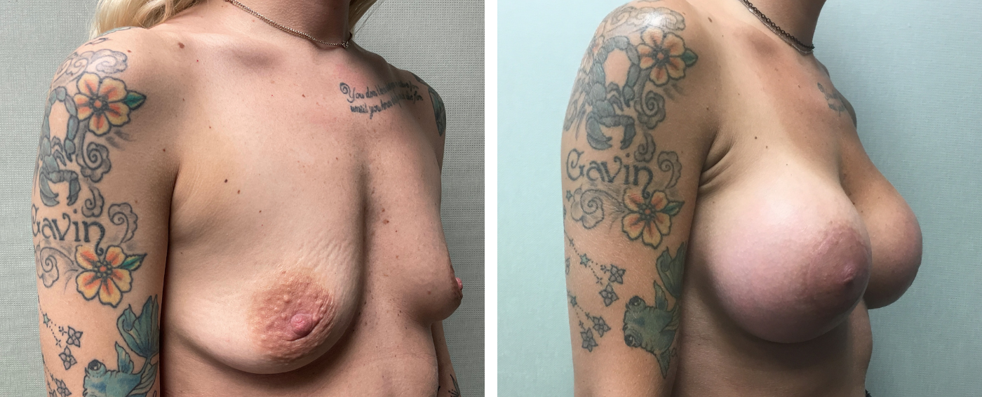 Breast Aug Periareolar lift b