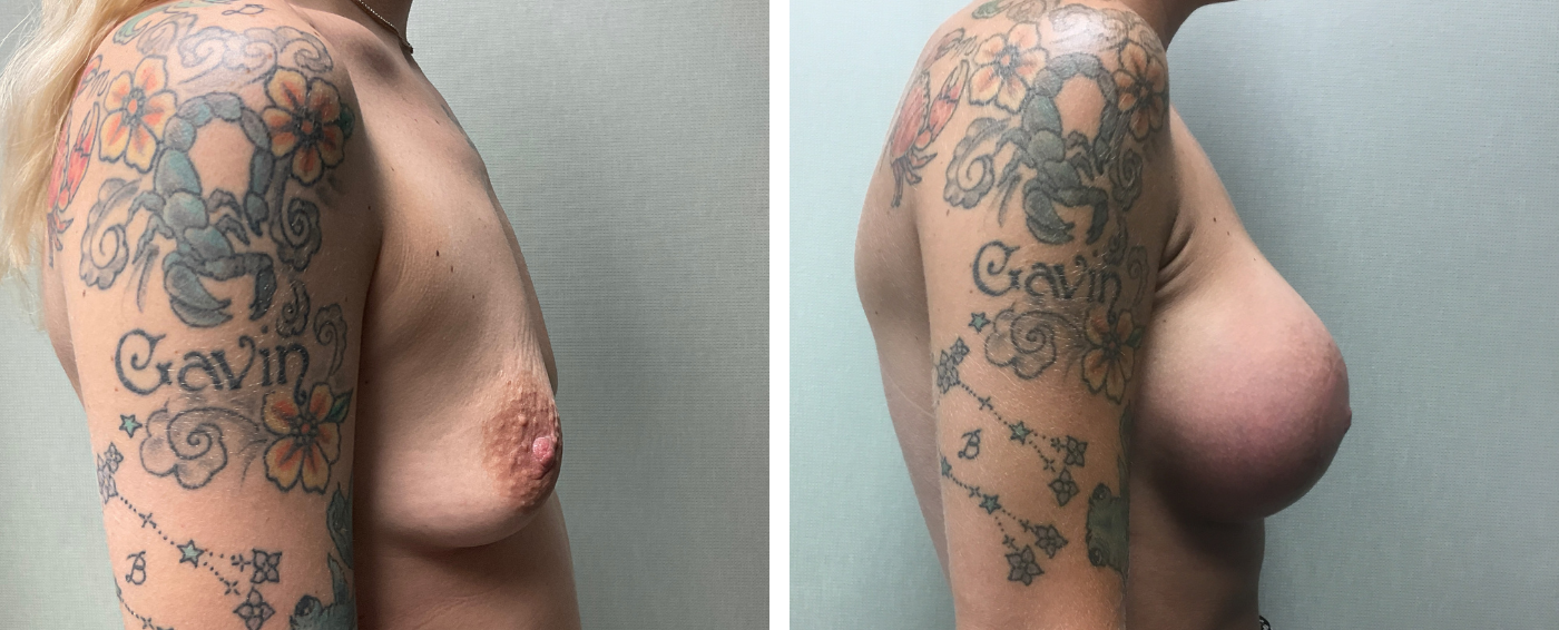 Breast Aug Periareolar lift c