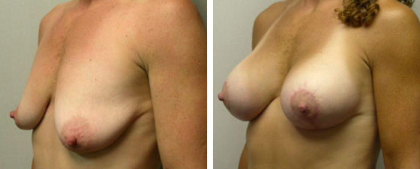 Breast Augmentation with Lollipop Lift b