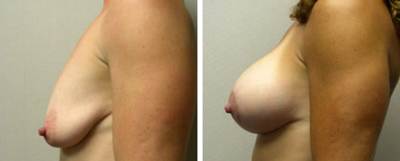 Breast Augmentation with Lollipop Lift c