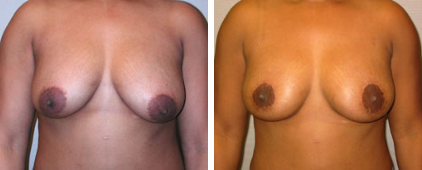 Breast lift a