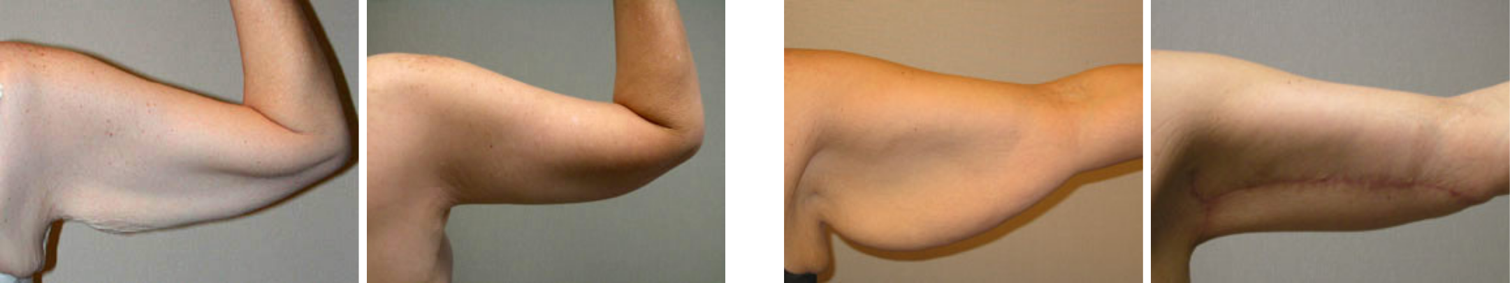 Best Arm Lift In Michgian ()