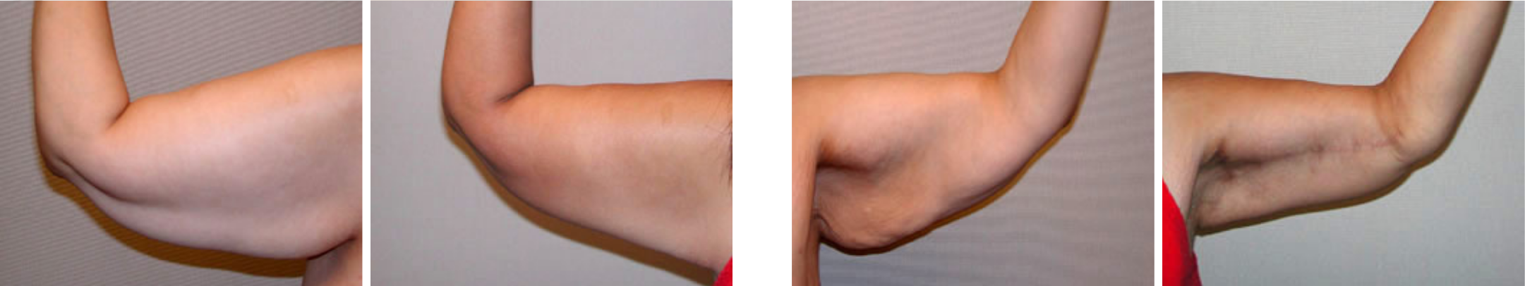 Best Arm Lift In Michgian () Best Arm Lift In Michgian ()