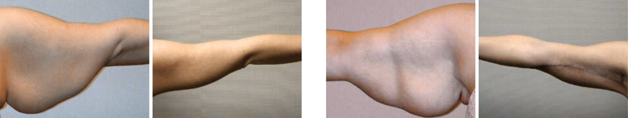 Best Arm Lift In Michgian () Best Arm Lift In Michgian ()