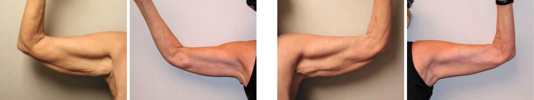 Best Arm Lift In Michgian () Best Arm Lift In Michgian ()