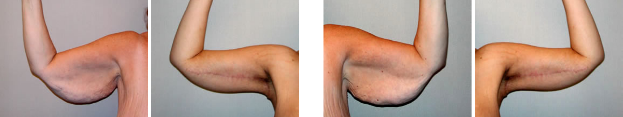 Best Arm Lift In Michgian () Best Arm Lift In Michgian ()