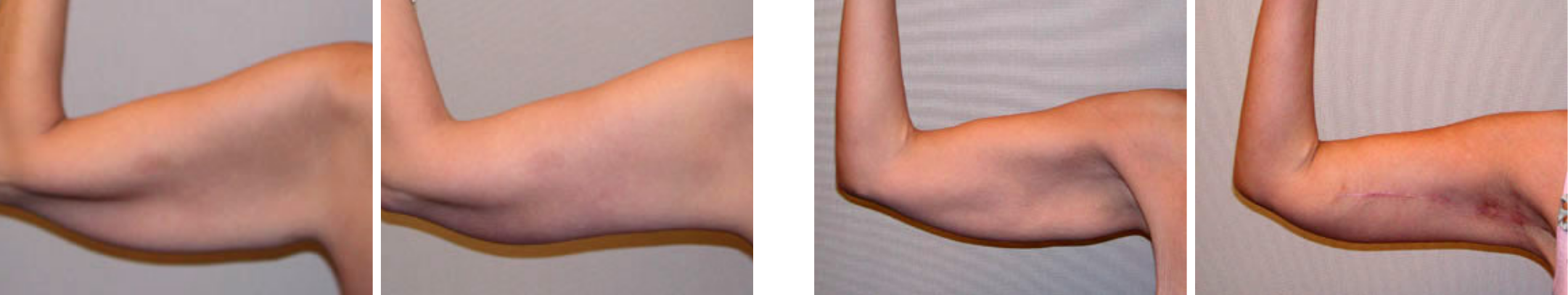 Best Arm Lift In Michgian Best Arm Lift In Michgian