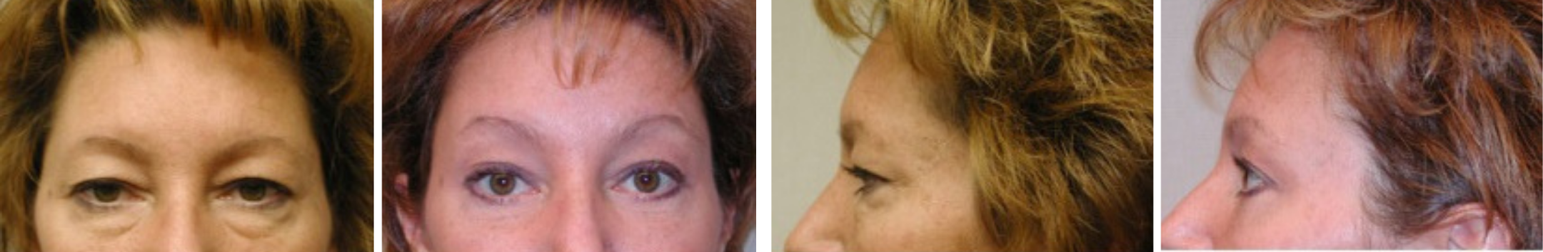 Best Brow Lift In Michigan () Best Brow Lift In Michigan ()