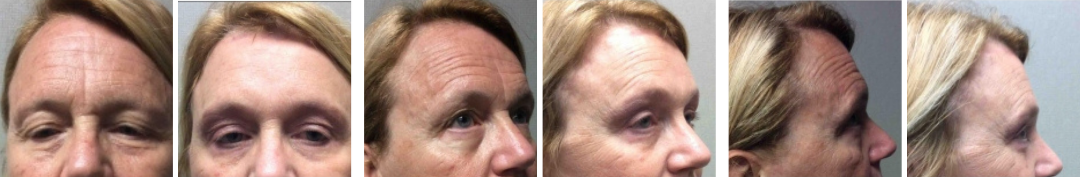 Best Brow Lift In Michigan Best Brow Lift In Michigan