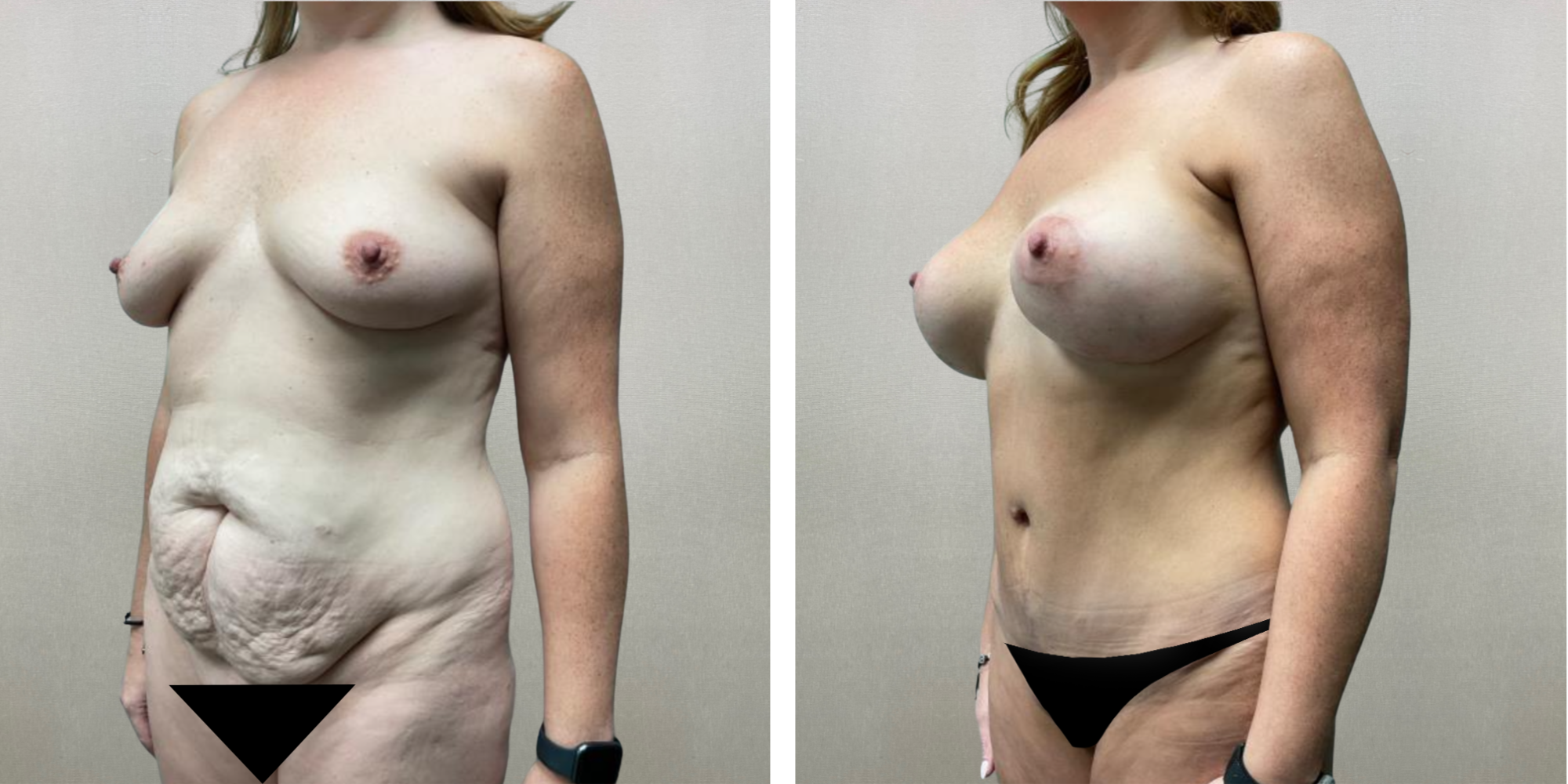 Best Mommy Makeover in Birmingham Michigan ()