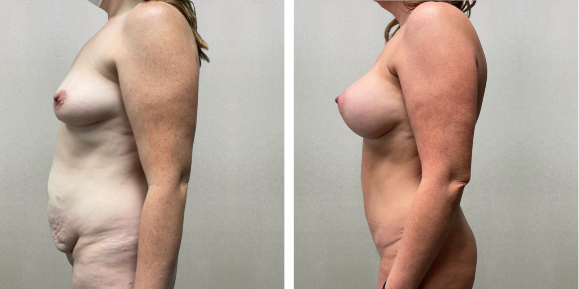 Best Mommy Makeover in Birmingham Michigan ()