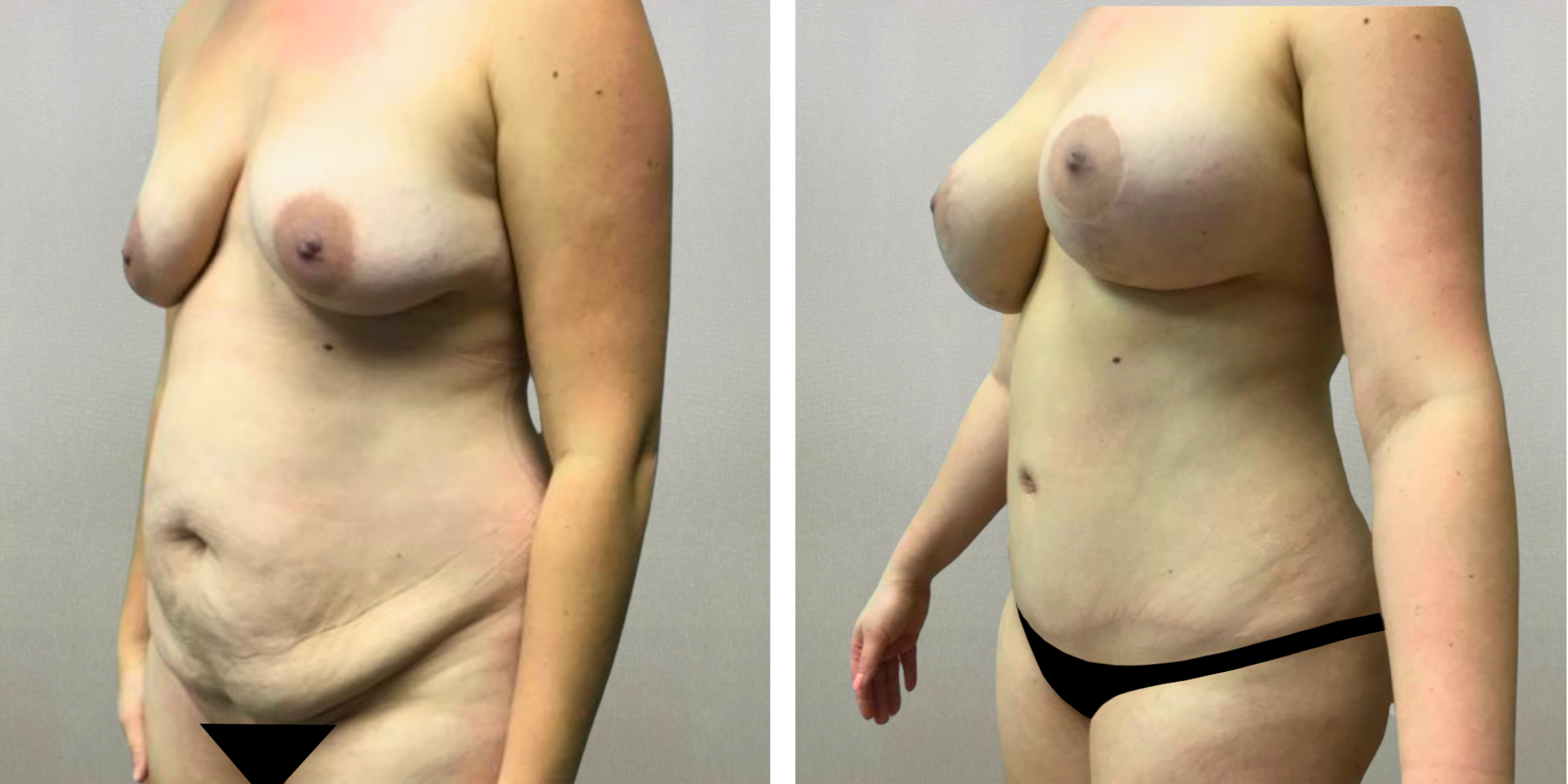 Best Mommy Makeover in Detroit ()