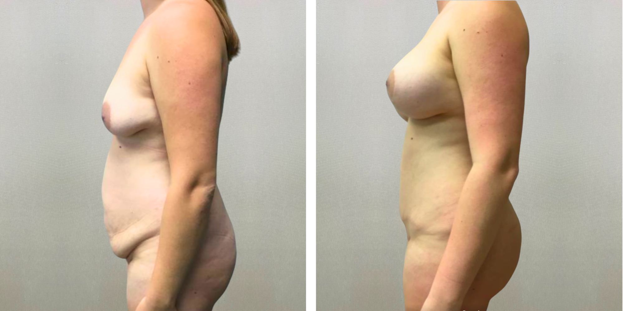 Best Mommy Makeover in Detroit ()