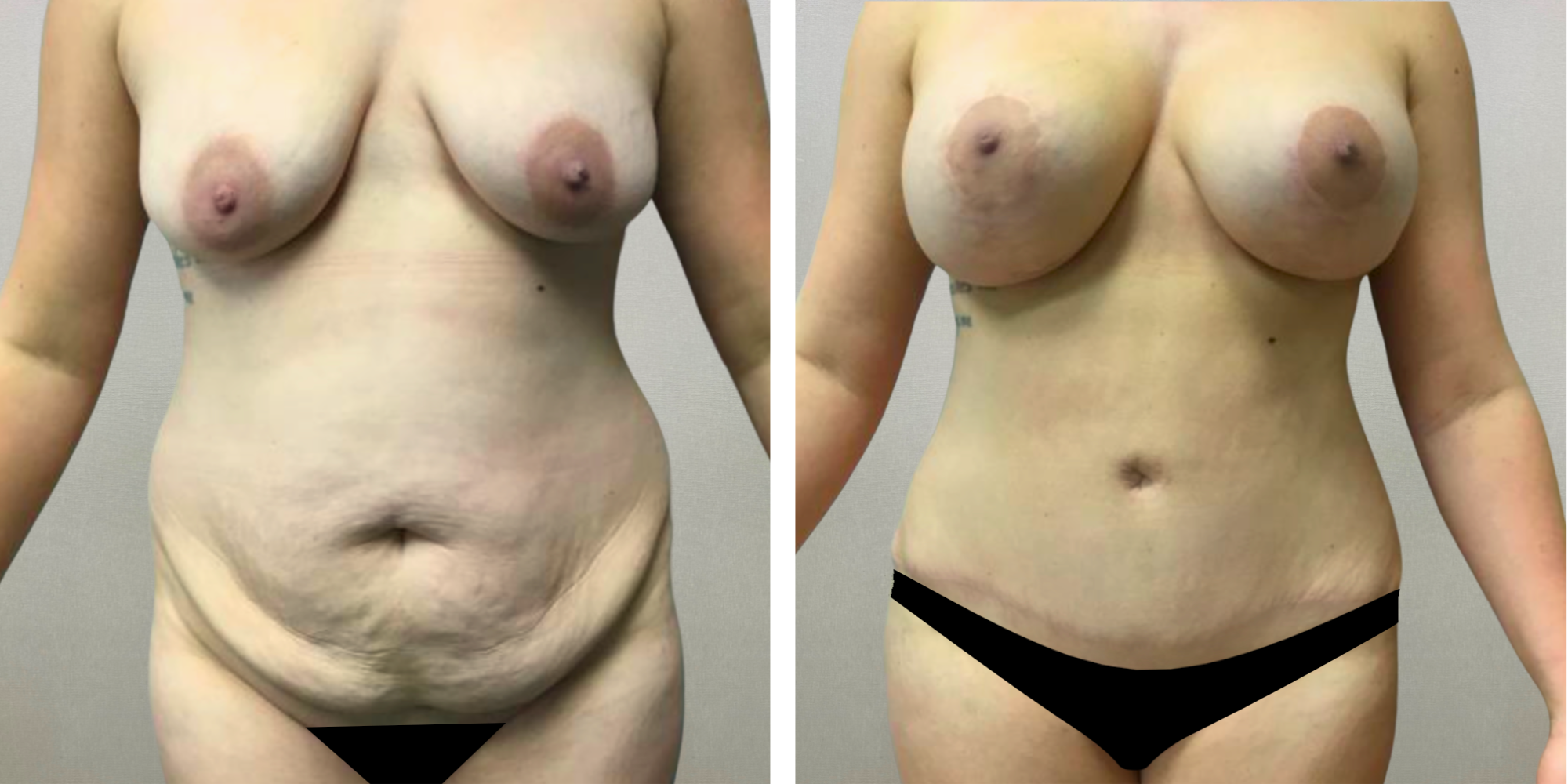 Best Mommy Makeover in Detroit