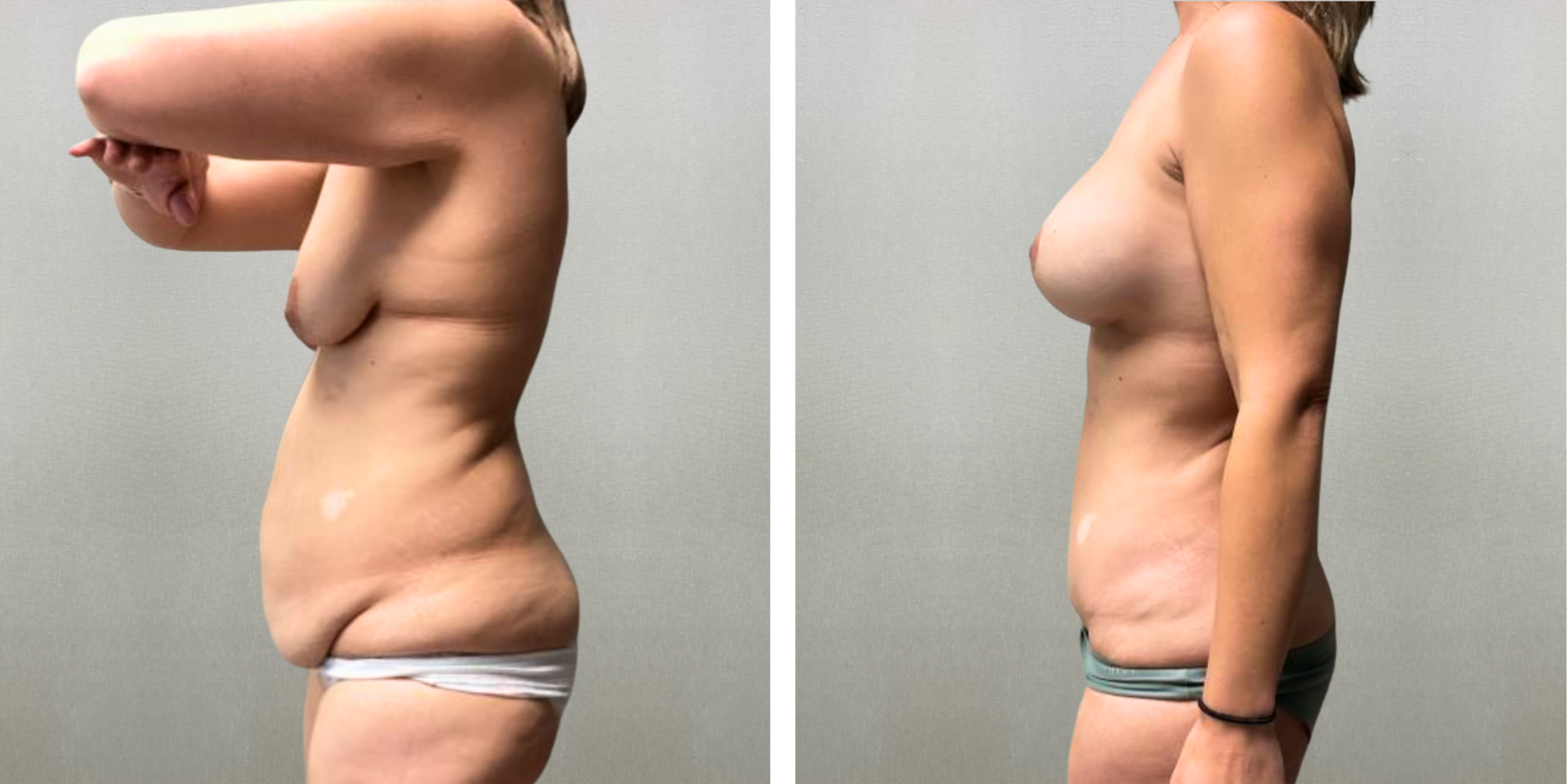 Best Mommy Makeover in Farmigton Hills Michigan ()