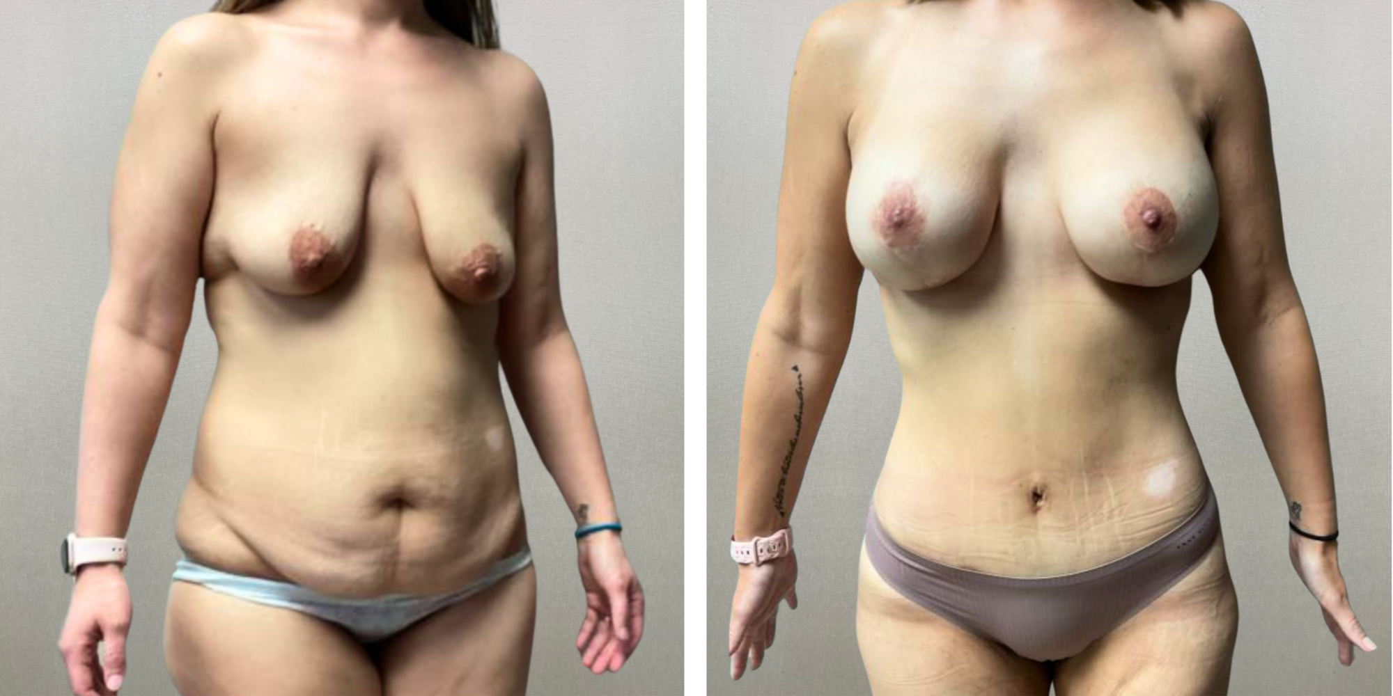 Best Mommy Makeover in Farmigton Hills Michigan