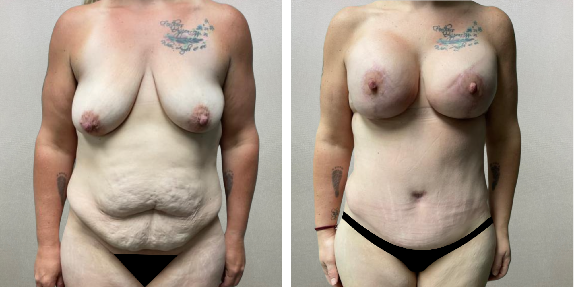 Best Mommy Makeover in Michigan